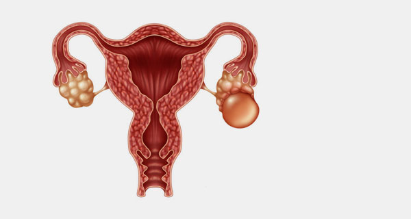 Over Kisti Ameliyatı (Kapalı Yumurtalık Kisti Ameliyatı)