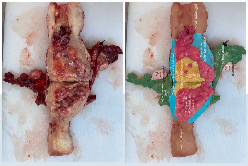 Endometrium kanserli bir hastanın rahimi ortadan ikiye kesildikten sonraki tümörün, tümör olmayan endometriumun (rahim iç tabakasın), myometrium (rahim kas tabakası), tüpler ve yumurtalıkların önden görünümü