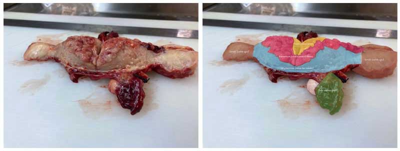 Endometrium kanserli bir hastanın rahimi ortadan ikiye kesildikten sonraki tümörün, tümör olmayan endometriumun (rahim iç tabakası), myometrium (rahim kas tabakası), tüpler ve yumurtalıkların yandan görünümü. Evre 1B tümörlerde tümör rahim kas tabakasının yarısına ulaşır veya daha fazlasına ilerler.