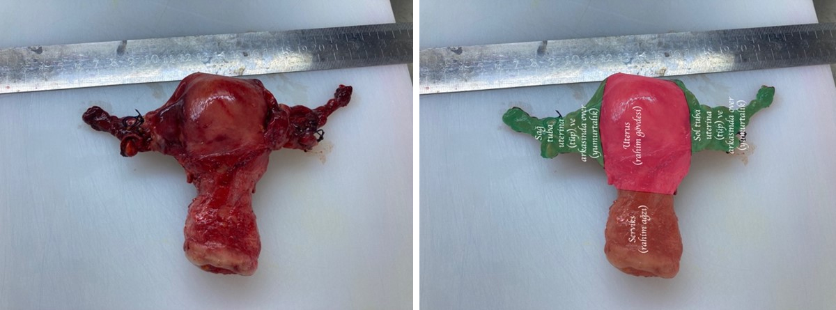 Rahim, tüpler ve yumurtalıkların önden görünümü