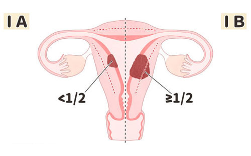 Endometrium Kanseri Evreleme: Aşamalar ve Tedavi