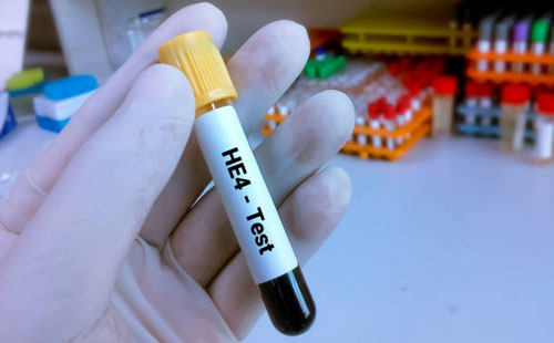 HE-4 Testi Nedir? Yumurtalık Kitlelerinde Ne Zaman Kullanılır?
