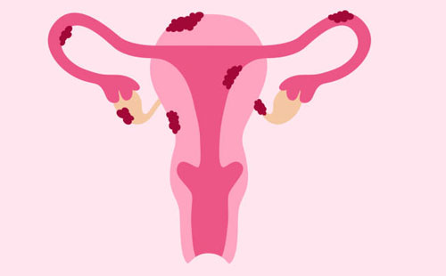 Kist Laparoskopi Ameliyatı: Bilmeniz Gerekenler