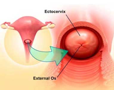 Ektoserviks ve external osun (rahim ağzı kanalının vajene açılan açıklığı) görünümü