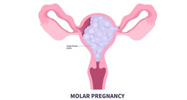 Gestasyonel Trofoblastik Tümörler