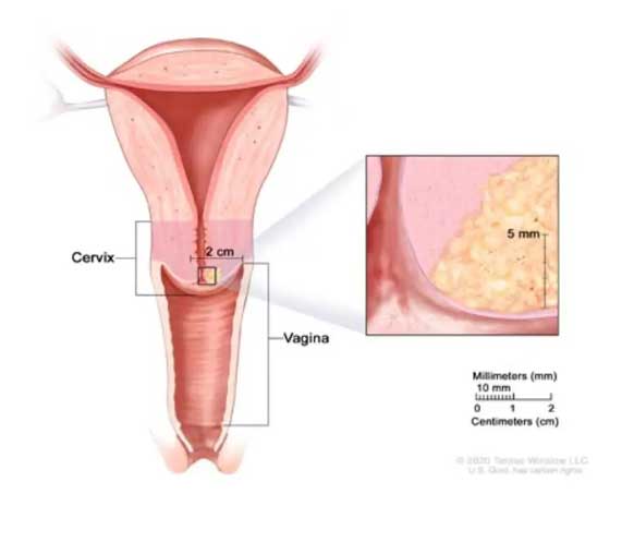 Evre 1B1 serviks kanserinde tümörün görünümü