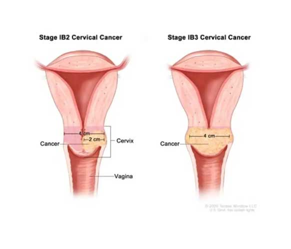 Evre 1B2 ve 1B3 serviks kanserinde tümörün görünümü