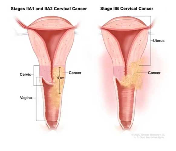 Evre 2A ve 2B serviks kanserinde tümörün görünümü