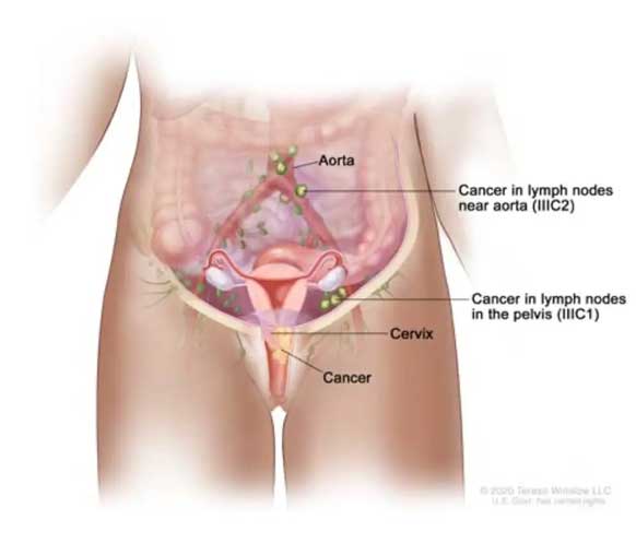 Evre 3C1 ve 3C2 serviks kanserinde lenf nodlarının tutulumunun gösterilmesi