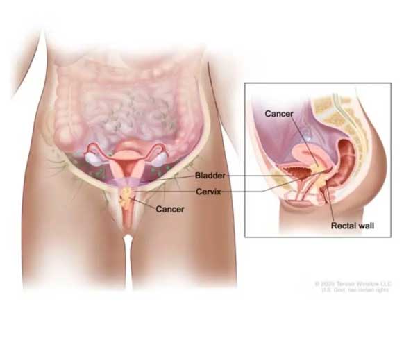 Evre 4A serviks kanserinde tümörün önde mesane arkada rektuma invazyonunun gösterimesi