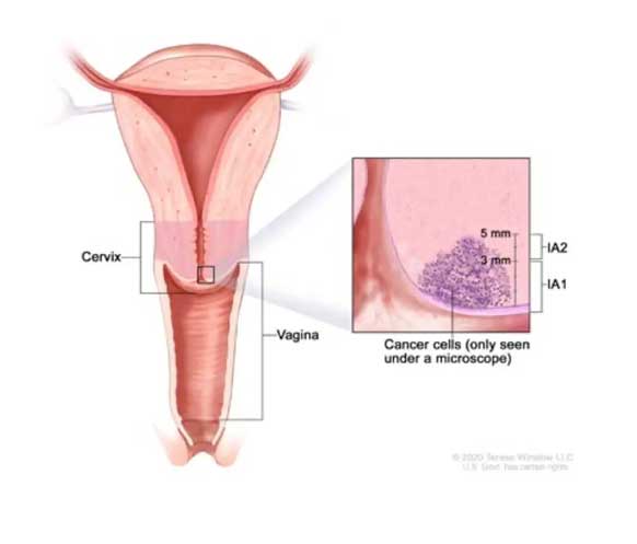 Evre 1A1 ve 1A2 serviks kanserinde tümörün görünümü