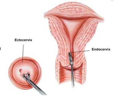 Servikal biyopsi alınması, B)endoservikal küretaj yapılması